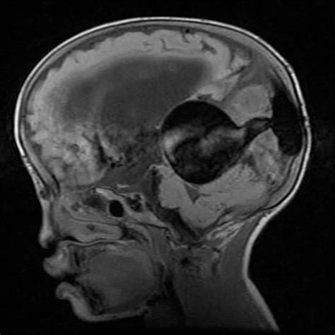 Vein of Galen aneurysmal malformation (VGAM's), probably better termed as median prosencephalic ...