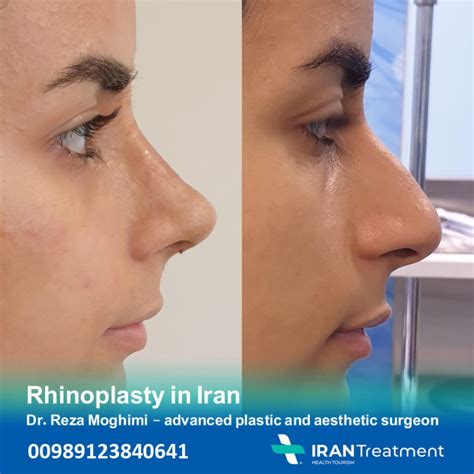 Rhinoplasty In Iran Dr Mohammad Reza Moghimi Irantreatments