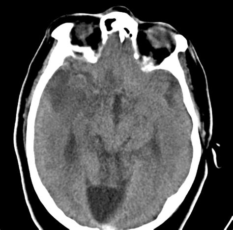 Diagnostic Delay In A Case Of Herpes Simplex Encephalitis Bmj Case