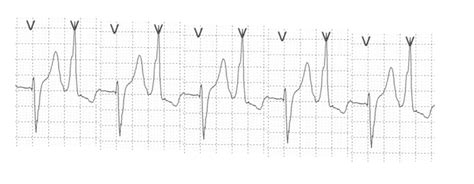 Diagnosis of ventricular tachycardia – All About Cardiovascular System and Disorders