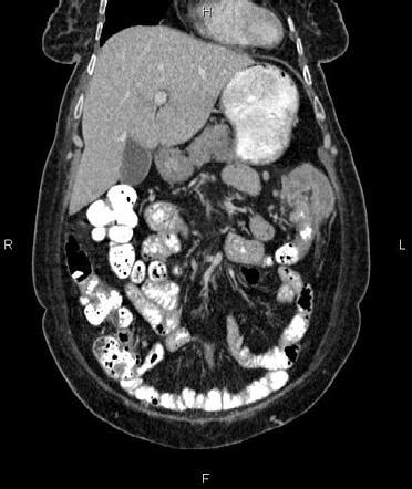 Colocolic Intussusception Due To Tumoral Infiltration Radiology Case