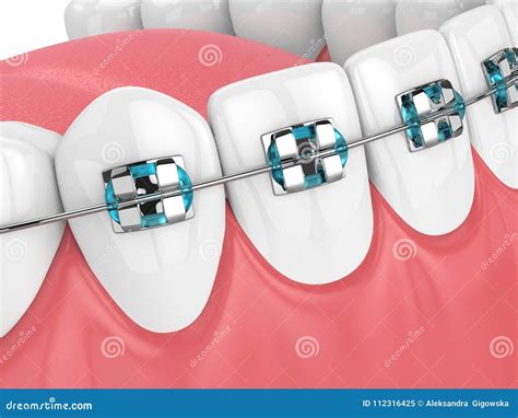 3d Render Of Jaw With Teeth And Orthodontic Braces Stock Image