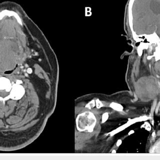 Contrast Enhanced Computed Tomography Ct Of The Neck A Large Right