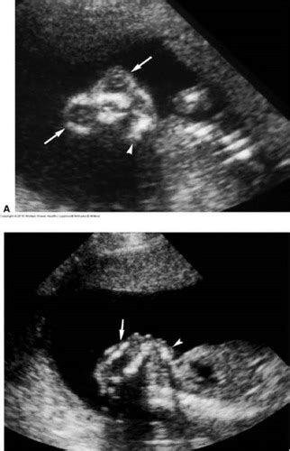 Davies Review Chapter 24 The Fetal Head And Brain Flashcards Quizlet