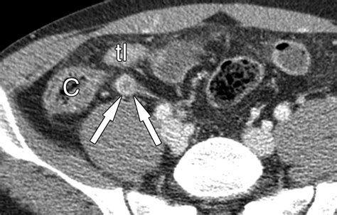 Acute Appendicitis In Young Adults Low Versus Standard Radiation Dose