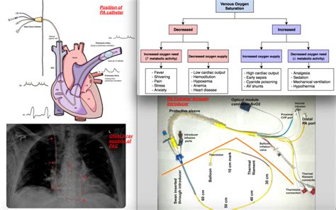 Anesthesia Monitoring Of Mixed Venous Saturation Statpearls Ncbi Bookshelf