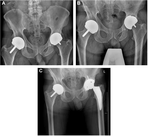 Hueter Anterior Approach For Metal On Metal Hip Resurfacing