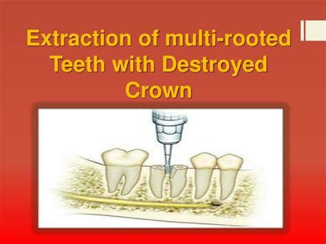 Ppt Mechanical Principles For Tooth Extractions Powerpoint