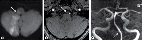 Mri Of Cerebellar Infarction Semantic Scholar