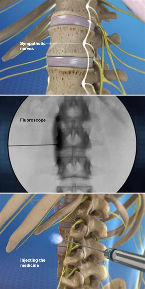 Pain Treatment Nj Pain And Spine