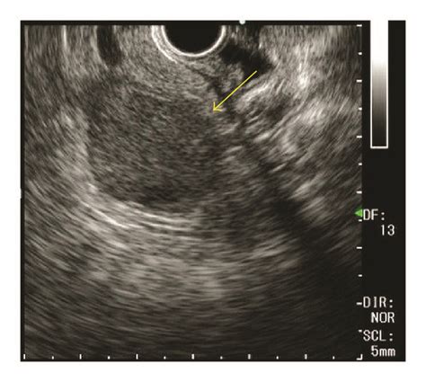 Endoscopic Ultrasonography Eus Imaging Sections Of Pancreas Tumors Download Scientific