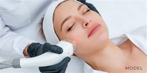 Genius Radio Frequency Rf In Orange County Microneedling