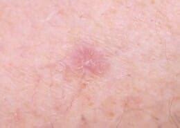 BCC (Basal Cell Carcinoma)