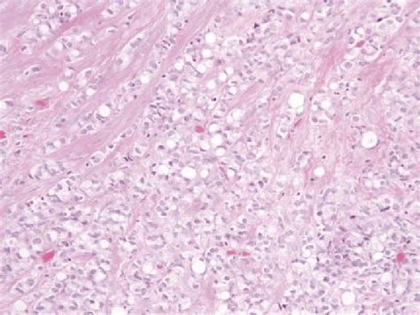 Signet Ring Cell Carcinoma Tumor Cells Diffusely Infiltrating The