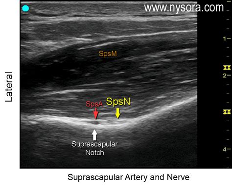 Suprascapular Nerve Block Ultrasound