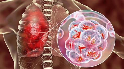 Tuberculosis Consiguen Descifrar El Mecanismo Infeccioso Más Importante De La Tuberculosis