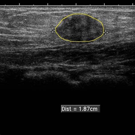 Endometriosis echocardiography or ultrasound - wikidoc