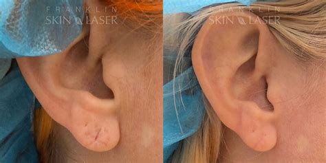 Earlobe Repair Before And Afters Franklin Skin And Laser