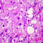 Figura N Biopsia Hep Tica Que Revela Discreta Esteatosis Y N Cleos