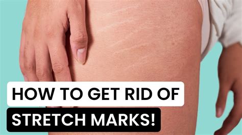 How To Get Rid Of Stretch Marks At Home Youtube