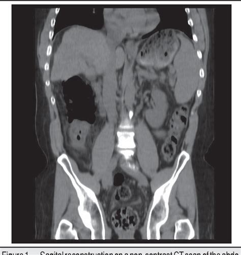 Figure From Intussusception And Colonic Ischemia In Portal