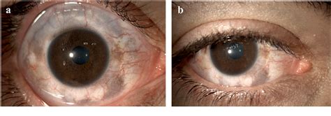 Figure 1 From Utility Of Anterior Segment Optical Coherence Tomography