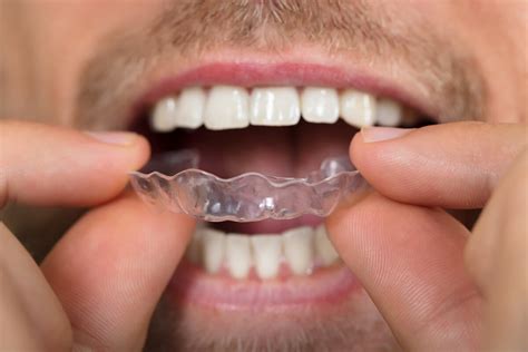 How Long Does Invisalign Take To Straighten Teeth