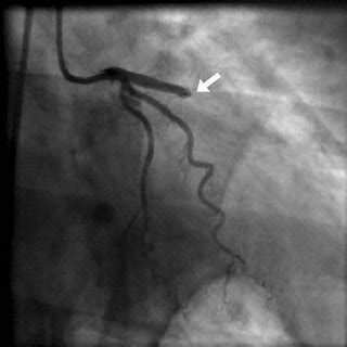 Occluded left anterior descending artery (arrow). | Download Scientific ...