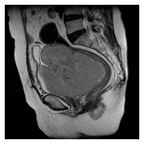 Sagittal T Weighted Magnetic Resonance Imaging Showing A Large Pelvic