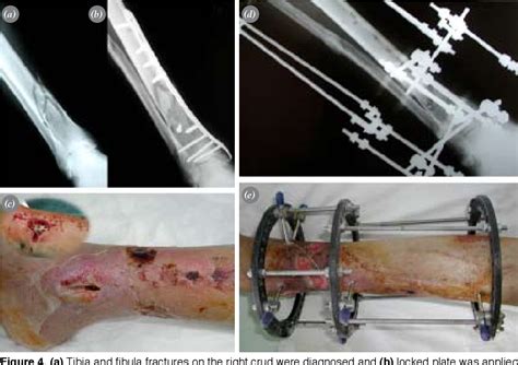 Pdf Use Of Vacuum Assisted Closure In The Topical Treatment Of