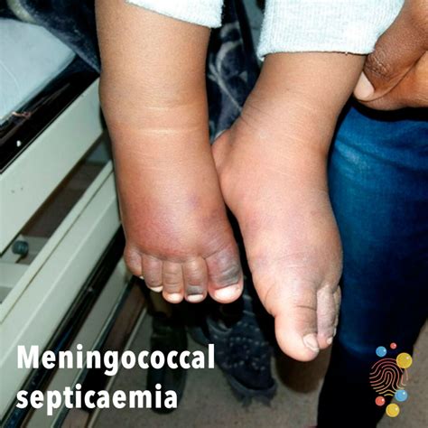 Meningococcal septicaemia - Skin Deep