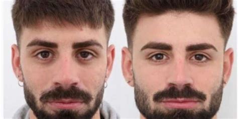 Qué es la masculinización facial el antes y después