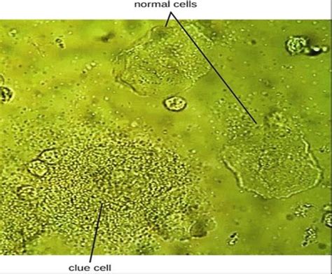 In This Vaginal Smear The Cell At The Lower Left Is A Clue Cell With A