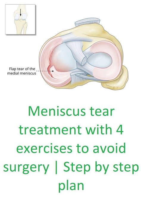 Meniscus tear treatment with 4 exercises to avoid surgery – Artofit