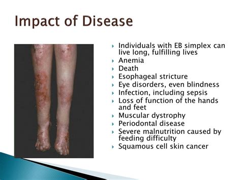 Ppt Epidermolysis Bullosa Simplex Powerpoint Presentation Free