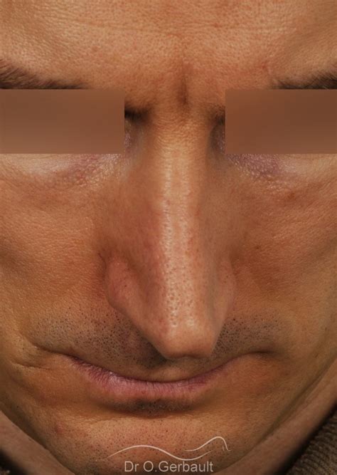 Photos De Rhinoplastie Chez L Homme Avant Et Apr S