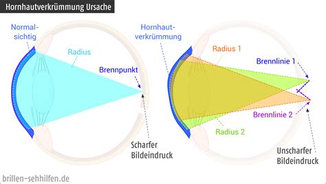 Astigmatismus Stabsichtigkeit Auge