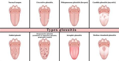 dysonfullgearsave: Healthy Normal Tongue Pictures