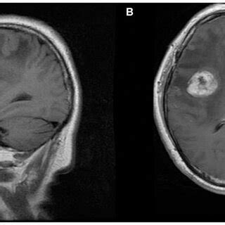 A 21 Year Old Woman With Supratentorial Intraparenchymal Anaplastic