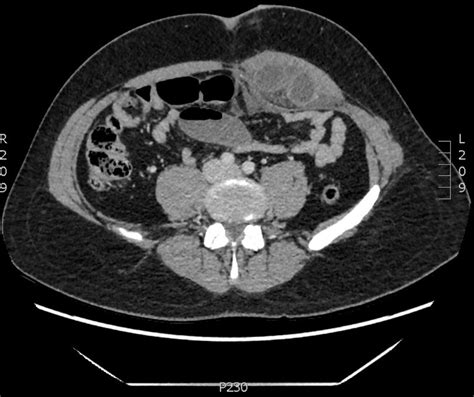 Strangulated Small Bowel Obstruction Complicating Totally Extra