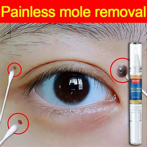 Beauty Removing Wart Pen Skin Mole Removal Pen Herbal Extract Serum