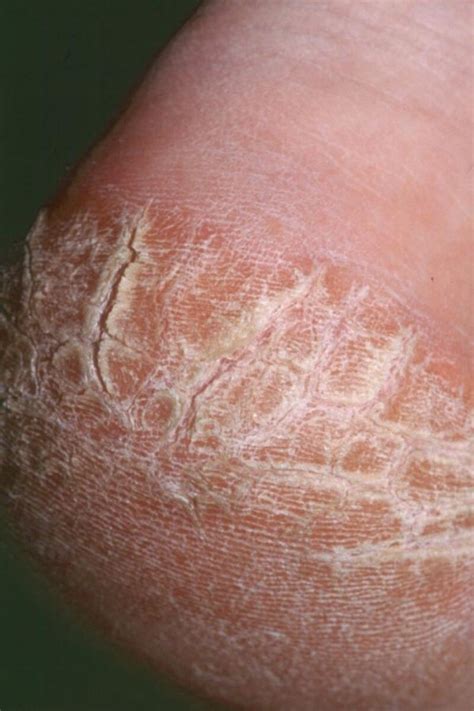 Palmoplantar Keratoderma