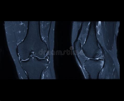 Comparaci N De La Imagen De La Rodilla De Mri O De Resonancia Magn Tica