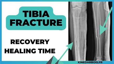 Tibia And Fibula Fracture Recovery Time