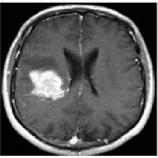 Lesion Patterns On Conventional MRI In Leukodystrophies And