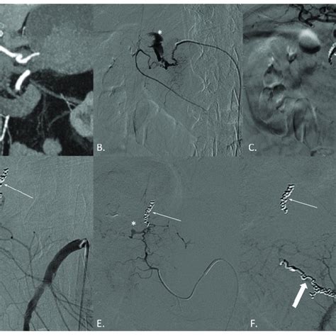 A F CT Angiography CTA And Digital Subtraction Angiography DSA Of