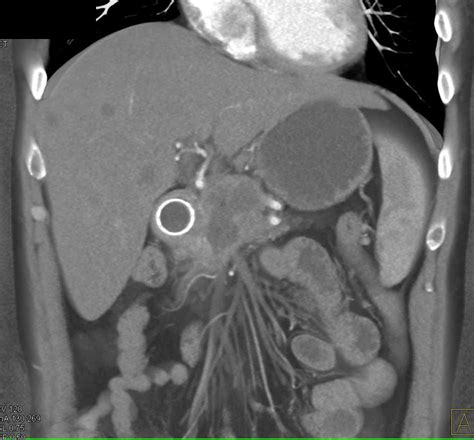 Pancreatic Cancer Invades The Duodenum And Liver Metastases Also Seen