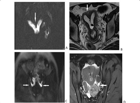 In 31 Year Old Woman Subtracted Dynamic 3d T1 Weighted Angiographic