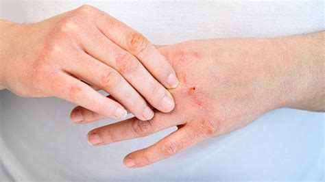 Contact Dermatitis Due To Detergent Allergy Recognize The Symptoms And