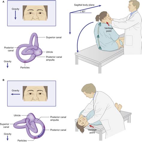 Dix Hallpike Maneuver And Epley Maneuver Indications 47 OFF